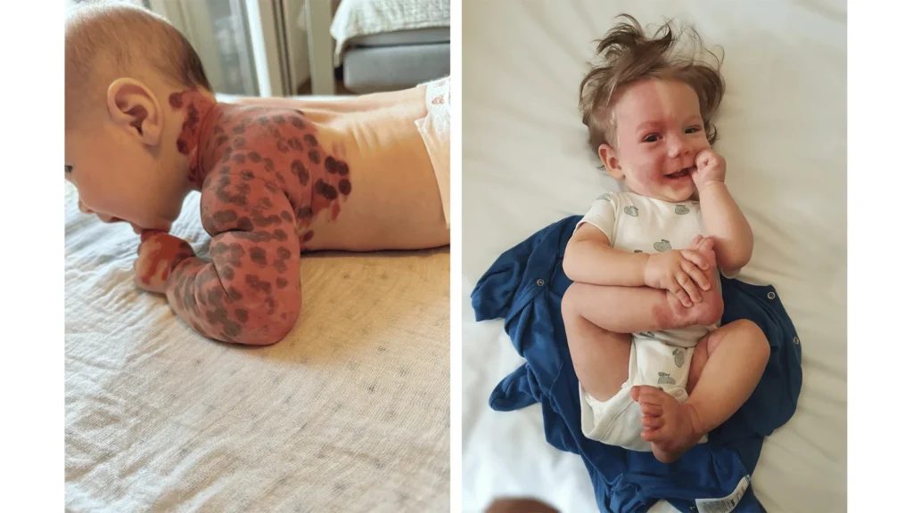 Dijete s Nevus Flammeusom prima laserski tretman Candela Vbeam PRO u Hrvatskoj