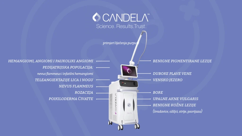 Dijete s Nevus Flammeusom prima laserski tretman Candela Vbeam PRO u Hrvatskoj